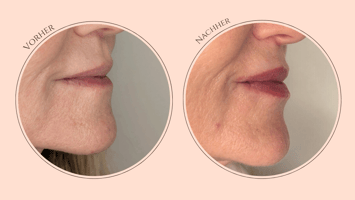 Vorher-Nachher-Vergleich einer natürlichen Lippenunterspritzung mit Hyaluron bei Seesthetics – Fokus auf Symmetrie und Amorbogen.