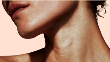 hautqualitaet-nach-polynukleotiden-seesthetics.png Alt-Text: Sichtbar gefestigte Hautstruktur und natürlicher Glow nach einer Kur mit Polynukleotiden bei Seesthetics.